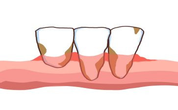 保护牙齿教案大班活动教案5篇